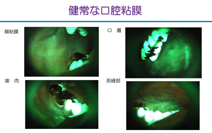 VELscope 健常口腔粘膜.jpg